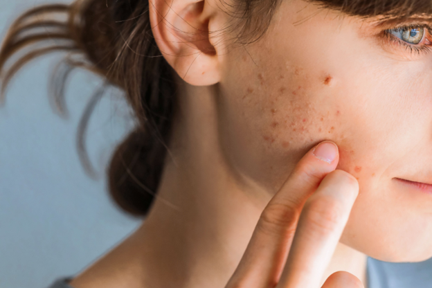 does collagen help with acne 